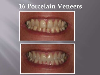 16 Porcelain Veneers
 