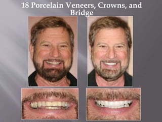 18 Porcelain Veneers, Crowns, and
Bridge
 