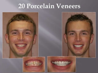20 Porcelain Veneers
 
