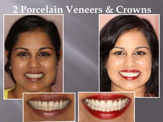2 Porcelain Veneers & Crowns
 