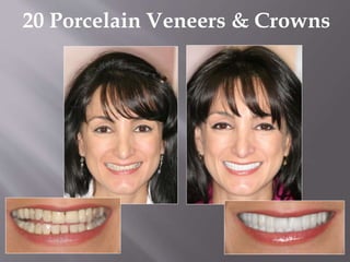 20 Porcelain Veneers & Crowns
 