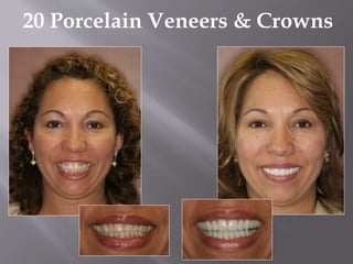 20 Porcelain Veneers & Crowns
 