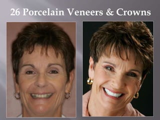 26 Porcelain Veneers & Crowns
 