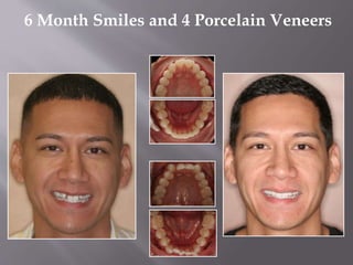 6 Month Smiles and 4 Porcelain Veneers
 