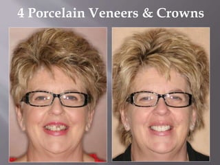 4 Porcelain Veneers & Crowns
 
