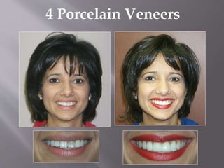 4 Porcelain Veneers
 