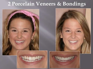 2 Porcelain Veneers & Bondings
 