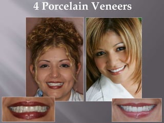 4 Porcelain Veneers
 
