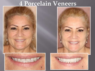 4 Porcelain Veneers
 