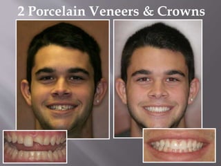 2 Porcelain Veneers & Crowns
 