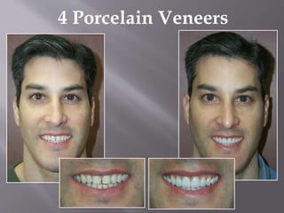 4 Porcelain Veneers
 