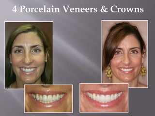 4 Porcelain Veneers & Crowns
 
