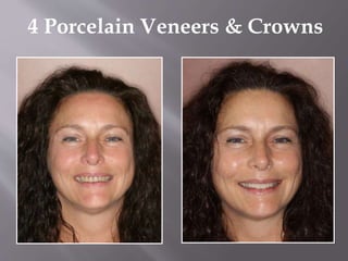 4 Porcelain Veneers & Crowns
 