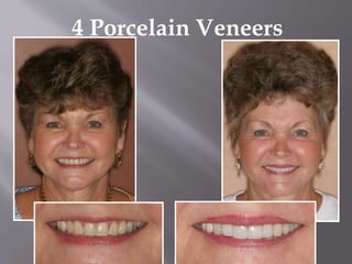 4 Porcelain Veneers
 