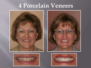 4 Porcelain Veneers
 