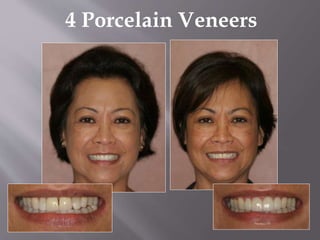 4 Porcelain Veneers
 