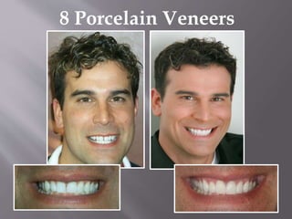 8 Porcelain Veneers
 