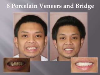 8 Porcelain Veneers and Bridge
 