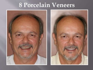 8 Porcelain Veneers
 