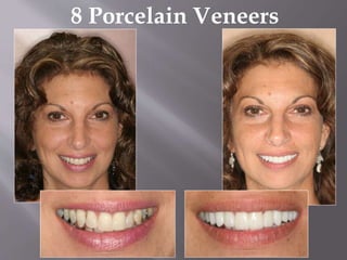 8 Porcelain Veneers
 