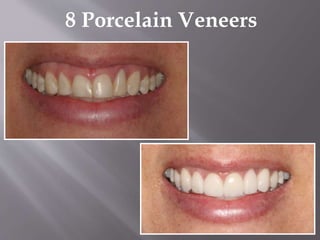 8 Porcelain Veneers
 