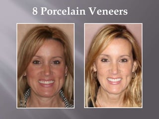 8 Porcelain Veneers
 