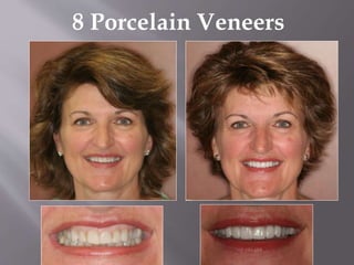 8 Porcelain Veneers
 
