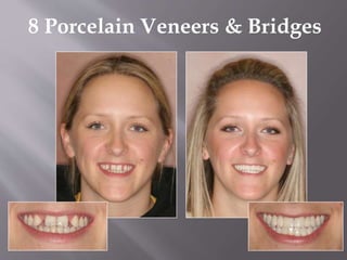 8 Porcelain Veneers & Bridges
 