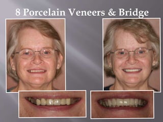 8 Porcelain Veneers & Bridge
 