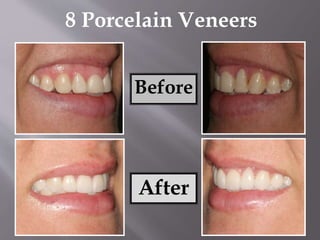 Before
After
8 Porcelain Veneers
 
