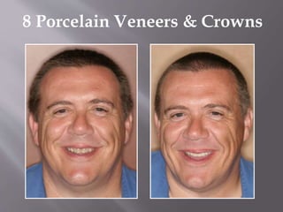 8 Porcelain Veneers & Crowns
 