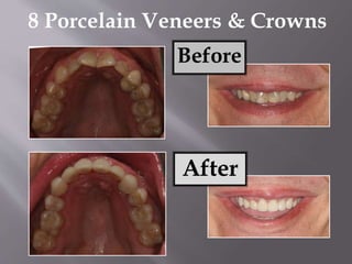 8 Porcelain Veneers & Crowns
Before
After
 