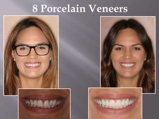8 Porcelain Veneers
 