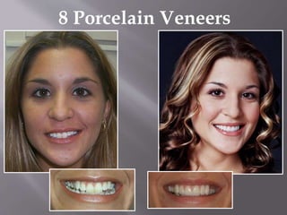 8 Porcelain Veneers
 