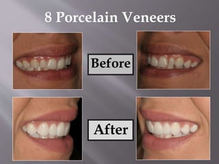 Before
After
8 Porcelain Veneers
 
