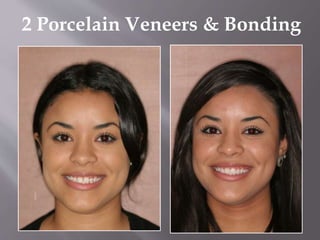 2 Porcelain Veneers & Bonding
 