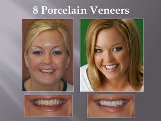 8 Porcelain Veneers
 