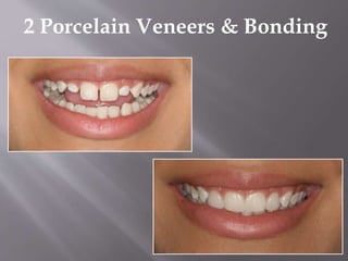 2 Porcelain Veneers & Bonding
 
