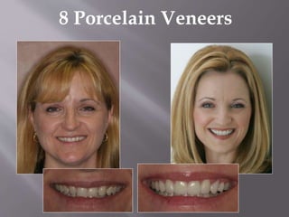 8 Porcelain Veneers
 