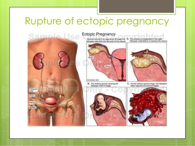 When do ectopic pregnancies occur