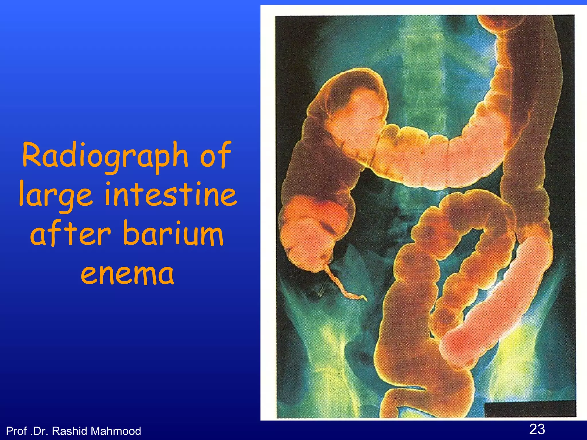 23Prof .Dr. Rashid Mahmood
Radiograph of
large intestine
after barium
enema
 
