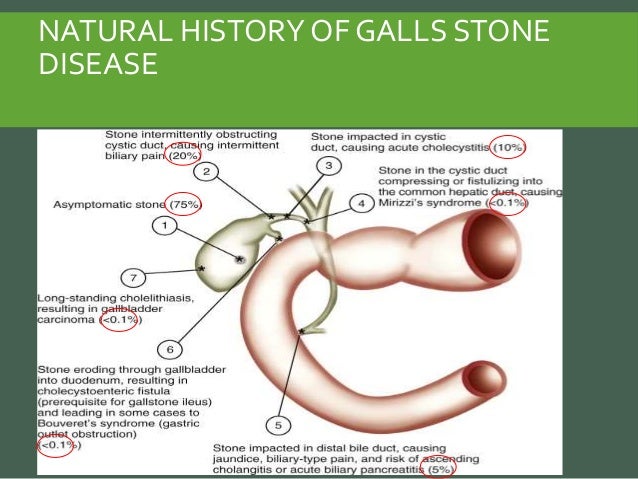 Acute Pancreatitis Natural History Acute Pancreatitis Natural History