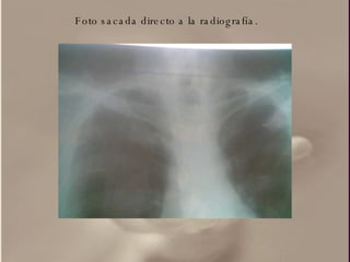 Foto sacada directo a la radiografía. 