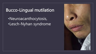 Bucco-Lingual mutilation
•Neuroacanthocytosis,
•Lesch-Nyhan syndrome
 