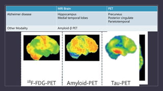 MRI Brain PET
Alzheimer disease Hippocampus
Medial temporal lobes
Precuneus
Posterior cingulate
Parietotemporal
Other Modality Amyloid-β PET
 
