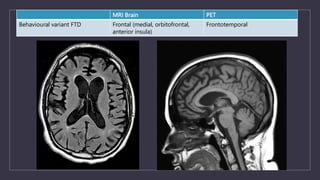 MRI Brain PET
Behavioural variant FTD Frontal (medial, orbitofrontal,
anterior insula)
Frontotemporal
 