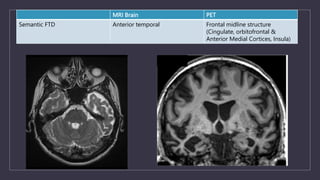 MRI Brain PET
Semantic FTD Anterior temporal Frontal midline structure
(Cingulate, orbitofrontal &
Anterior Medial Cortices, Insula)
 