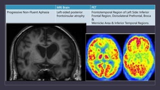 MRI Brain PET
Progressive Non-Fluent Aphasia Left-sided posterior
frontoinsular atrophy
Frontotemporal Region of Left Side: Inferior
Frontal Region, Dorsolateral Prefrontal, Broca
&
Wernicke Area & Inferior Temporal Regions.
 