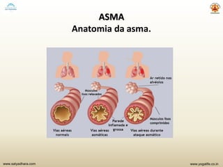 www.yogalife.co.inwww.satyadhara.com
ASMA
Anatomia da asma.
 