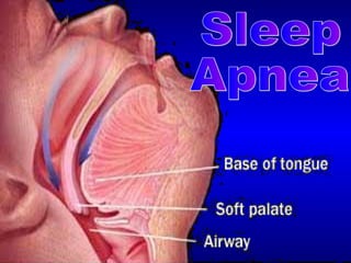 Sleep  Apnea 